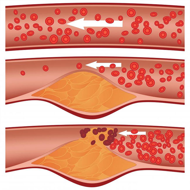 Can you reduce plaque in your arteries?