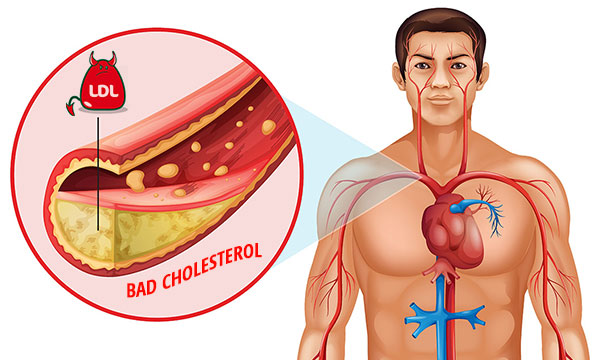 LDL_bad_cholesterol