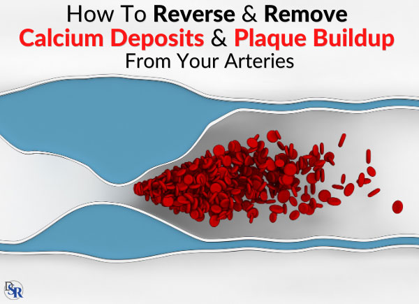 How To Reverse & Remove Calcium Deposits & Plaque Buildup From Your Arteries