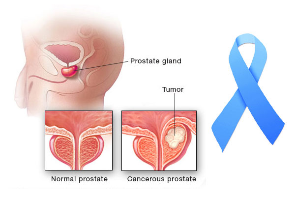 prostate problems