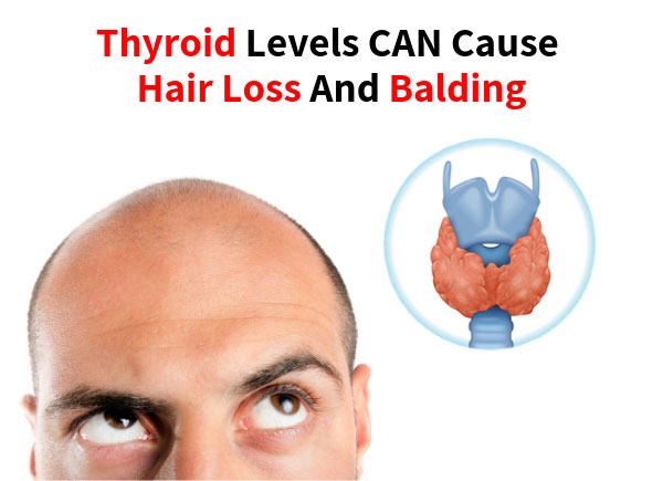 Thyroid levels CAN cause hair loss and balding