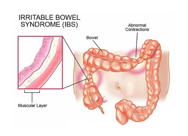  Irritable bowel syndrome