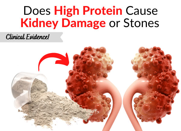 Does High Protein Cause Kidney Damage or Stones - Clinical Evidence