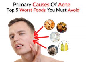 Primary Causes Of Acne - Top 5 Worst Foods You Must Avoid