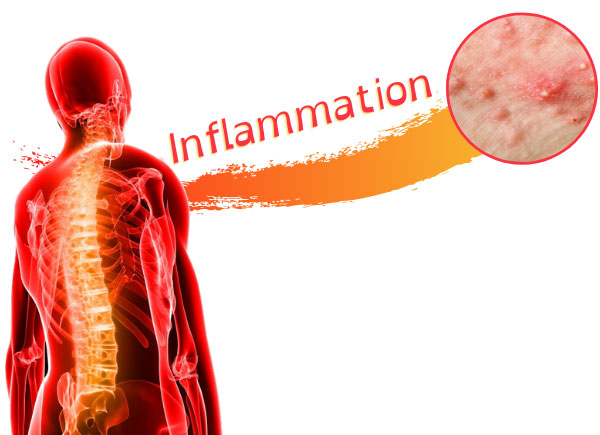 acne and inflammation