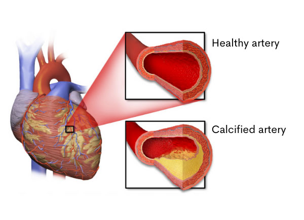 Calcified artery